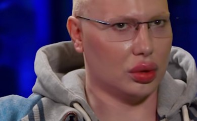 "Svi doktori koji su dirali moje lice upropastili su me" Brendon van sebe zbog estetskih intervencija