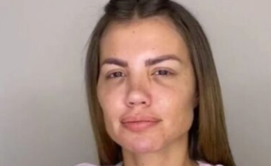 DRAGANA MITAR OPERISALA NOS ČAK OSAM PUTA: Bivša modelsica zbog estetskih operacija zamalo ostala bez nosa