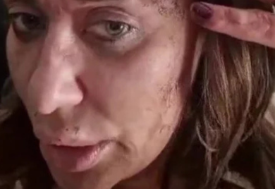 ANA NIKOLIĆ BRUTALNO PRETUČENA! Šok snimak pjevačice u ranama, pokazala jezive povrede