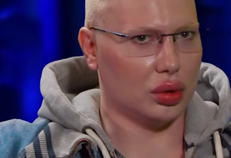"Svi doktori koji su dirali moje lice upropastili su me" Brendon van sebe zbog estetskih intervencija