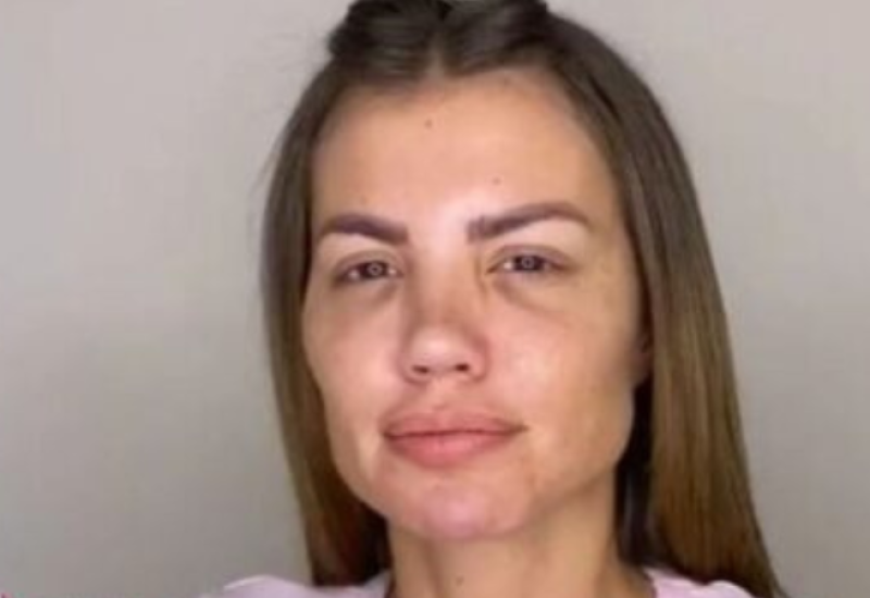 DRAGANA MITAR OPERISALA NOS ČAK OSAM PUTA: Bivša modelsica zbog estetskih operacija zamalo ostala bez nosa